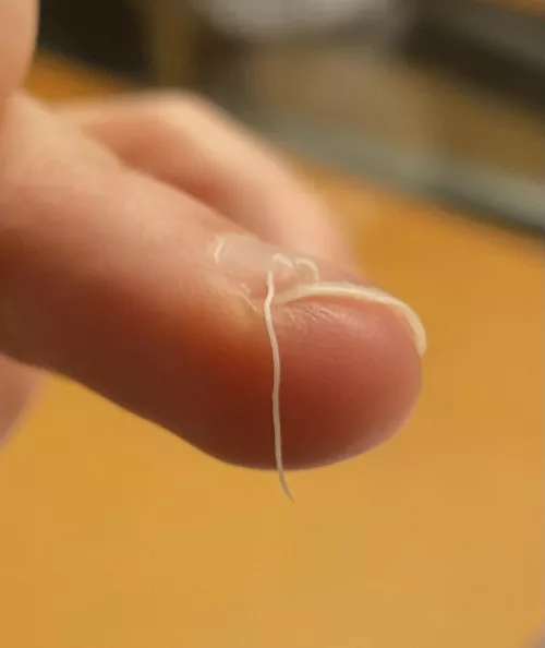 Extracted from a pore on my back - the longest ever!