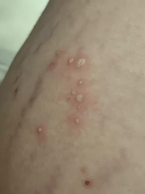 Inner thigh pustules