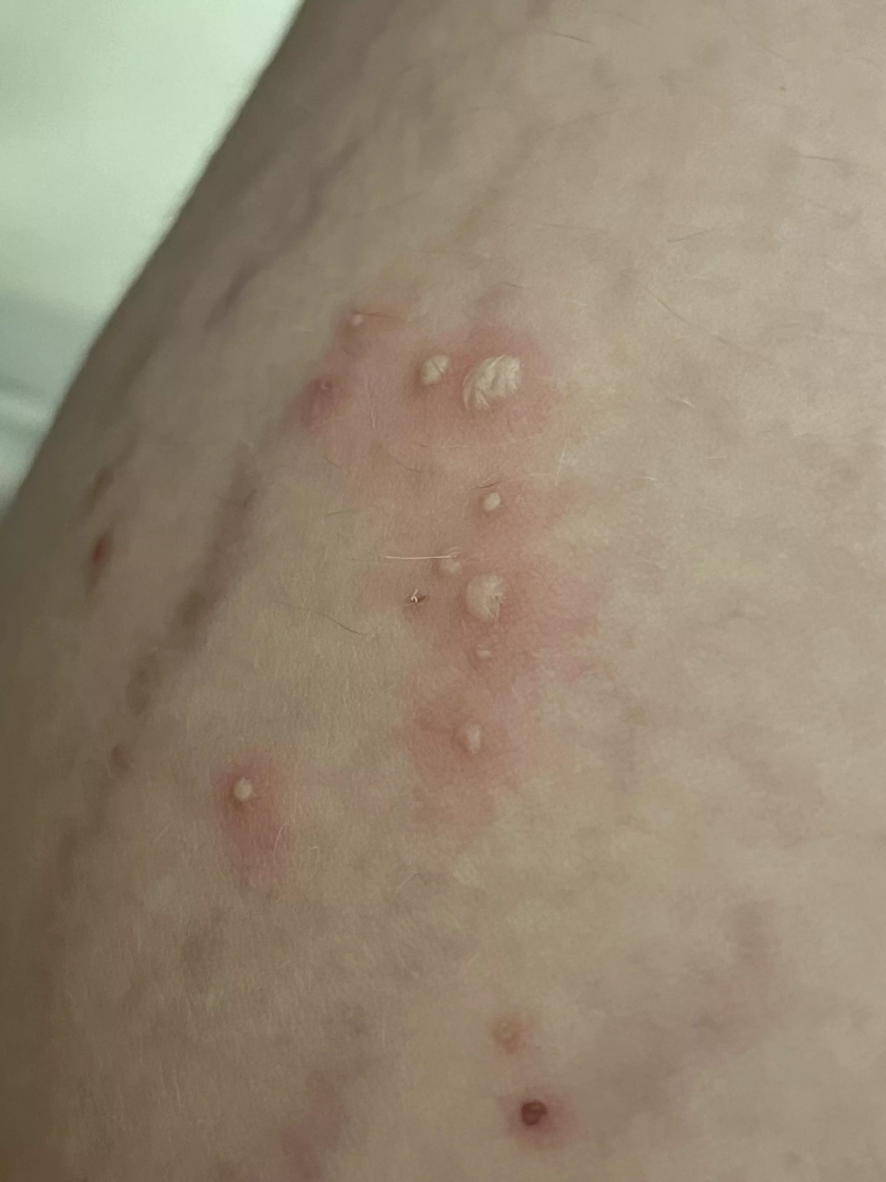 Inner thigh pustules