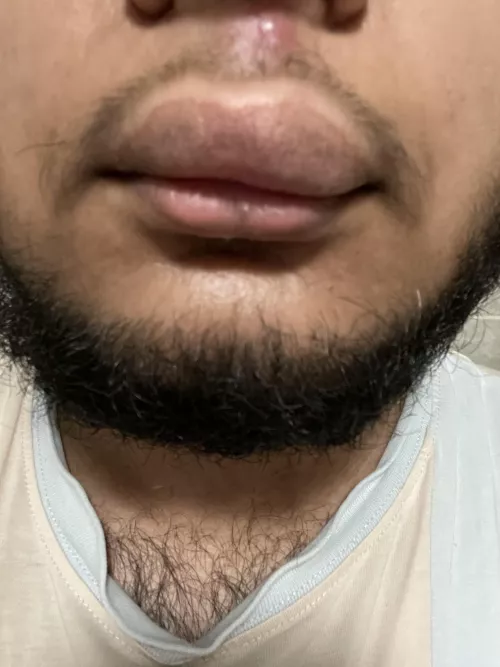 Popped a pimple on my lip and now it looks like this