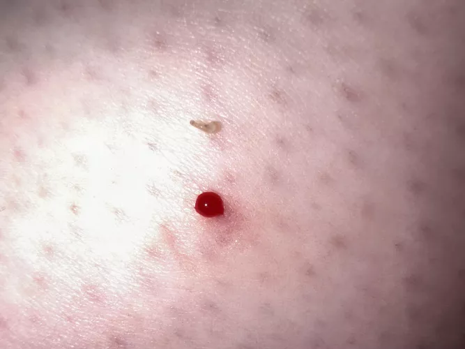 Popped this hard little teardrop-shaped nugget out of my leg