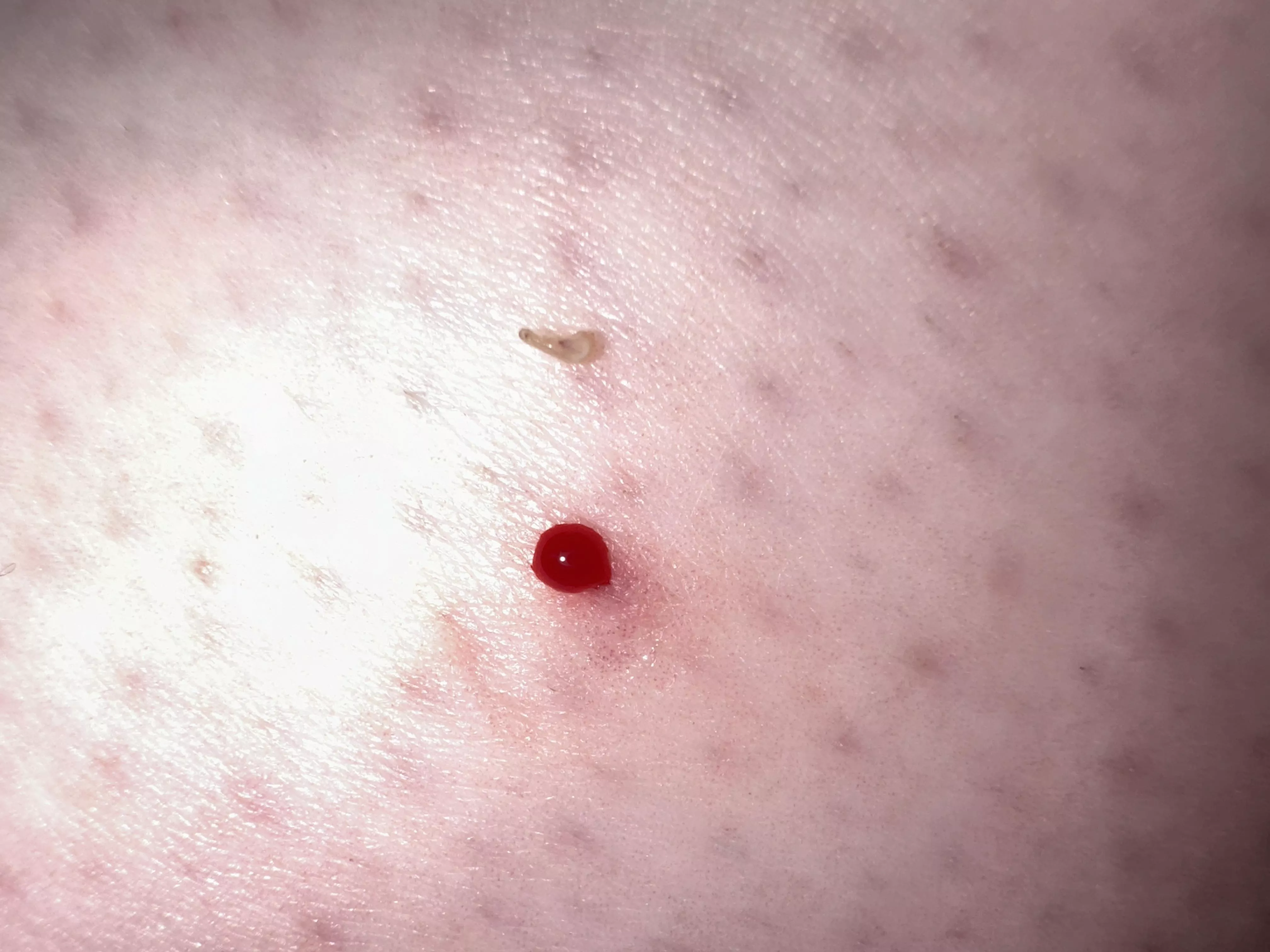 Popped this hard little teardrop-shaped nugget out of my leg