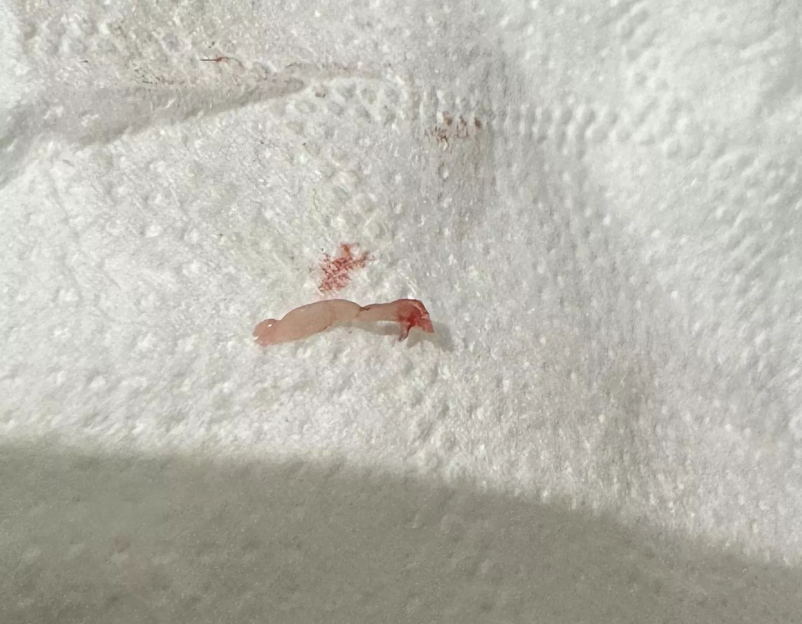 Cyst extracted thing?