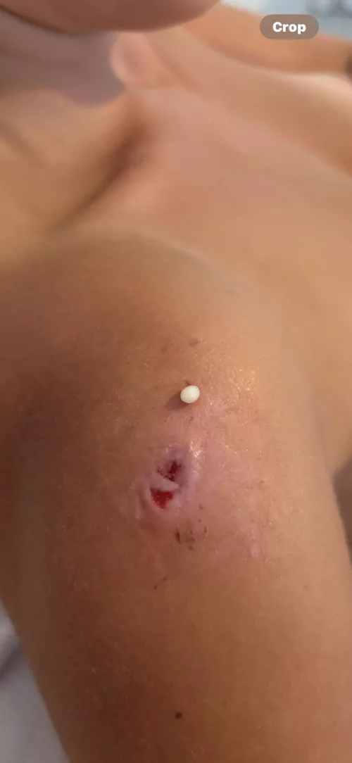 My recurring friend- tried an alternative removal process and didn't film as I didn't expect it to work!