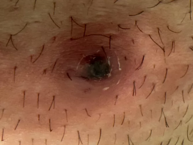 Longest ive ever had an ingrown