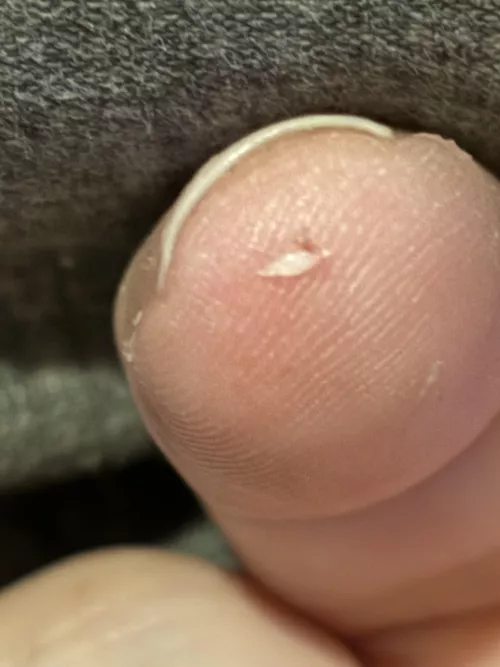 I get these weird angry hair follicles…