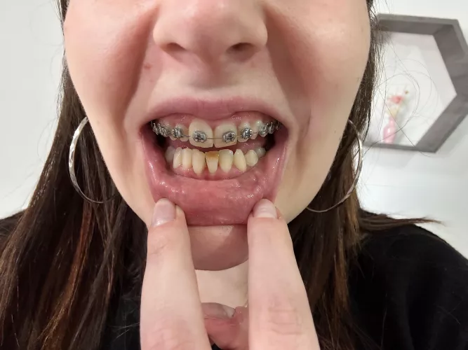 I’m going to start the thread to show my progress- Day 1 w braces