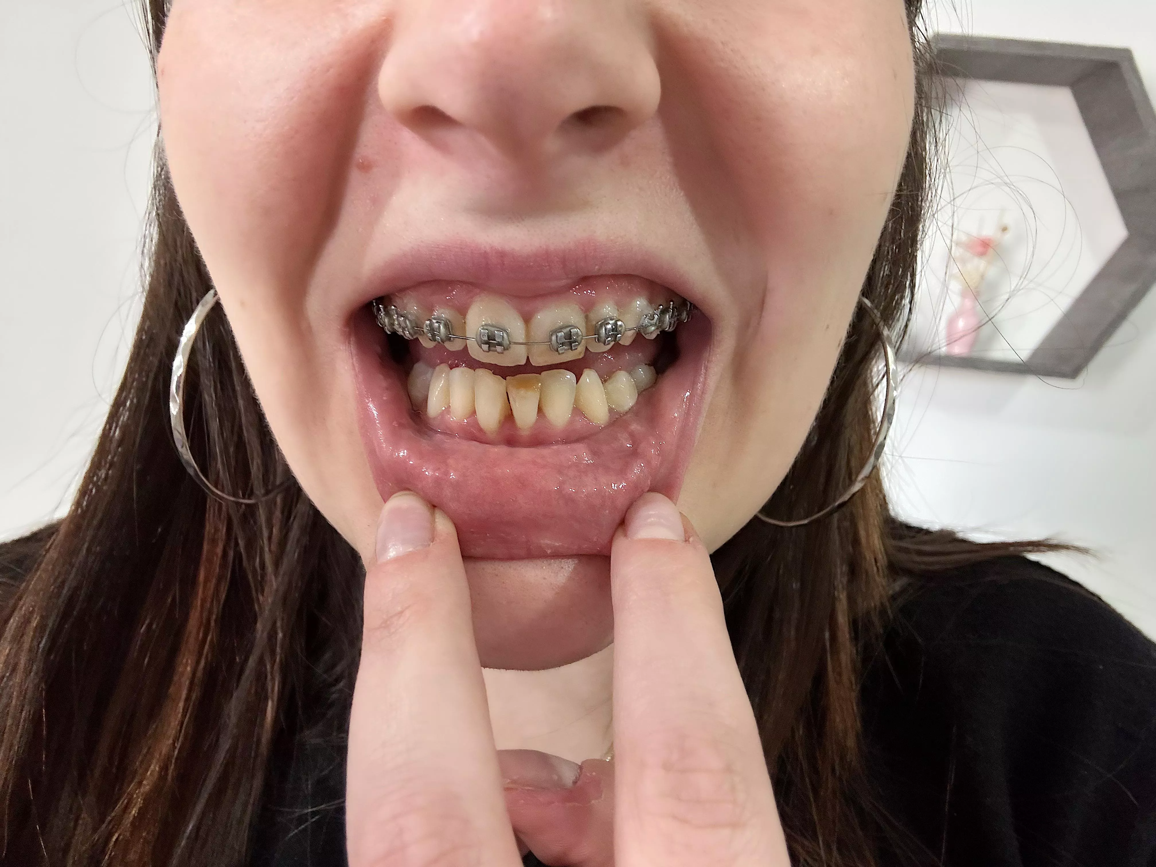 I’m going to start the thread to show my progress- Day 1 w braces