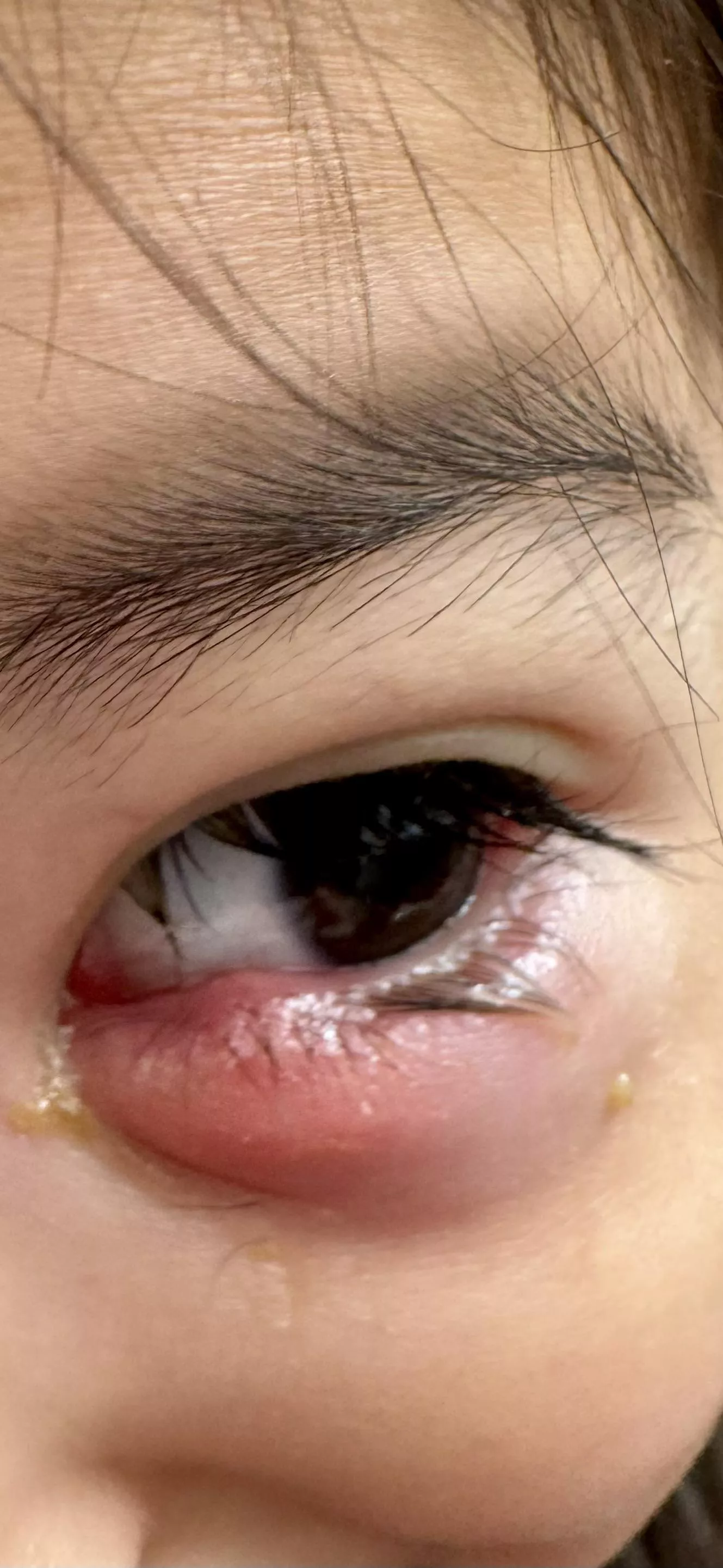 My 3yo’s infected stye. Forbidden pop (obviously)!