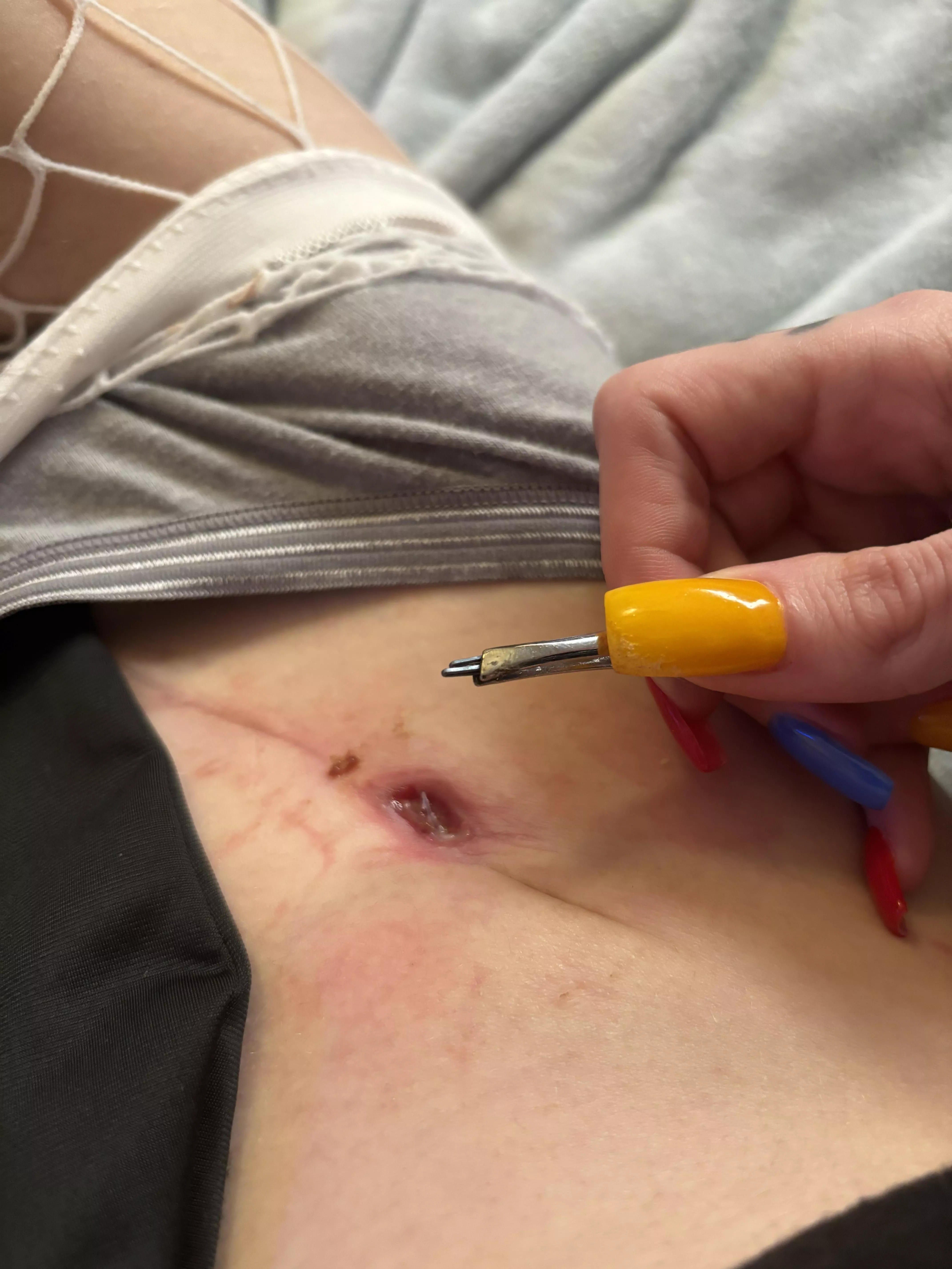 pulled out of my surgery scar