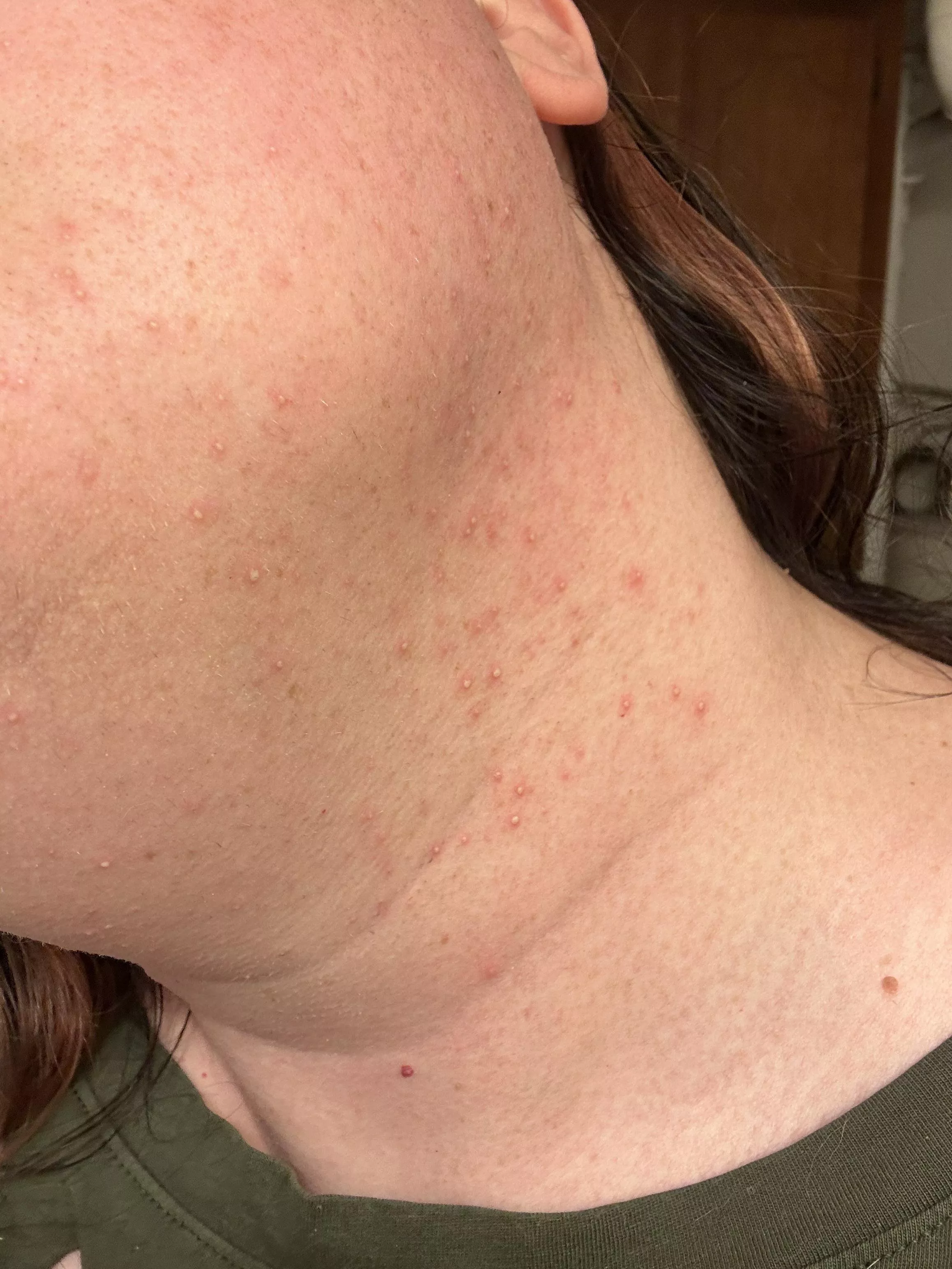 This is what my neck looks likes for a few days after doing laser hair removal. 