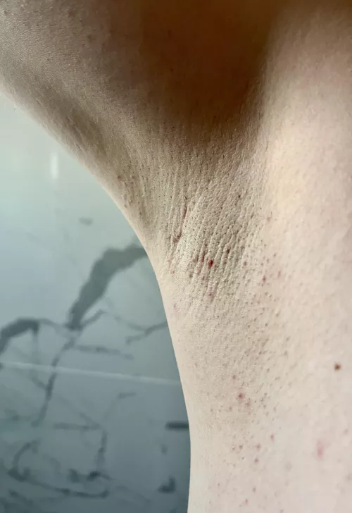 Stubble and razor burn