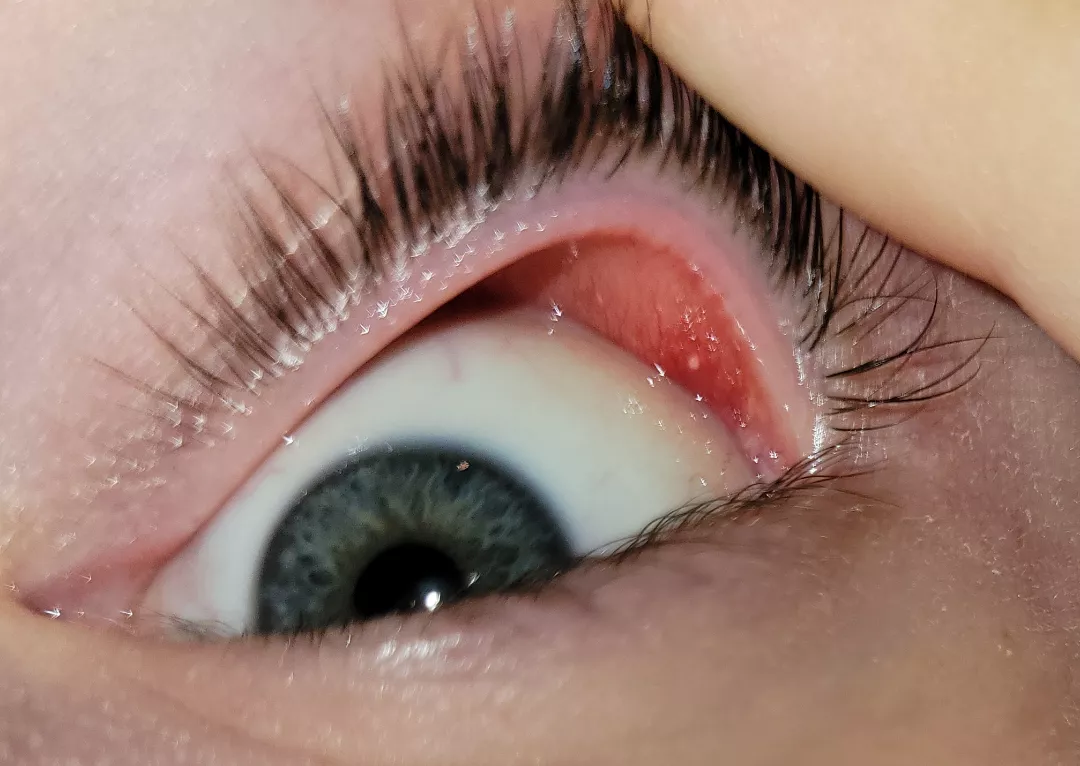 Biggest pimple (or maybe stye?) I've ever had under my eyelid