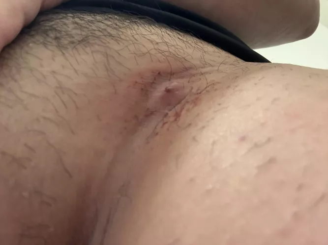 Ingrown hair cyst located in groin 