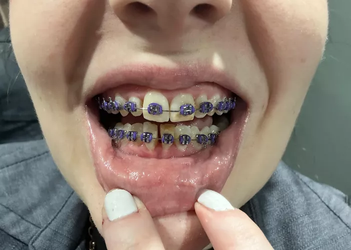 Thread to show my progress: 2 months and purple :3