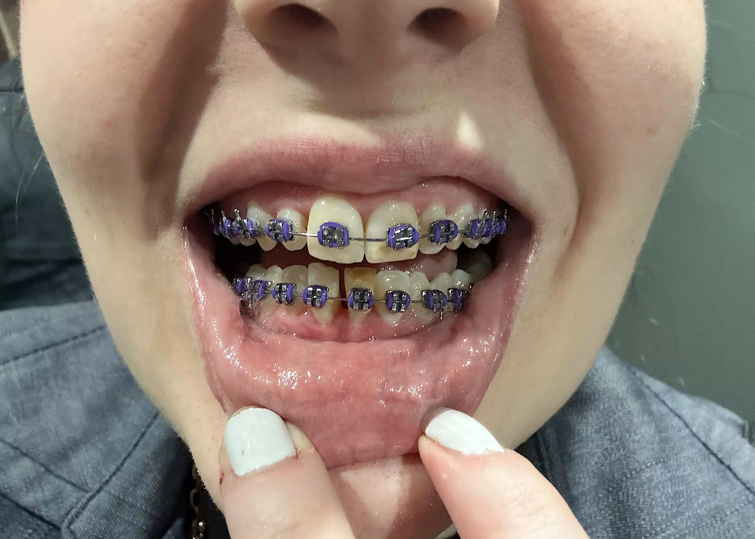 Thread to show my progress: 2 months and purple :3