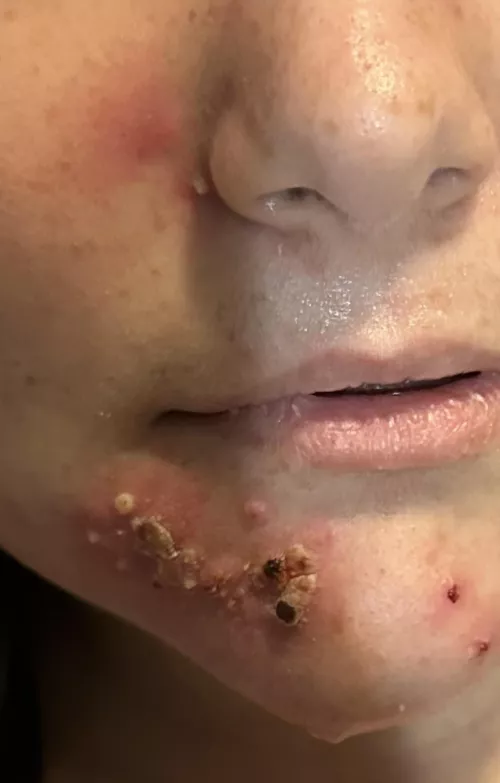 Caught a staph infection somehow. Ignore the sweat I was in the hospital for a Crohn's disease flare up 