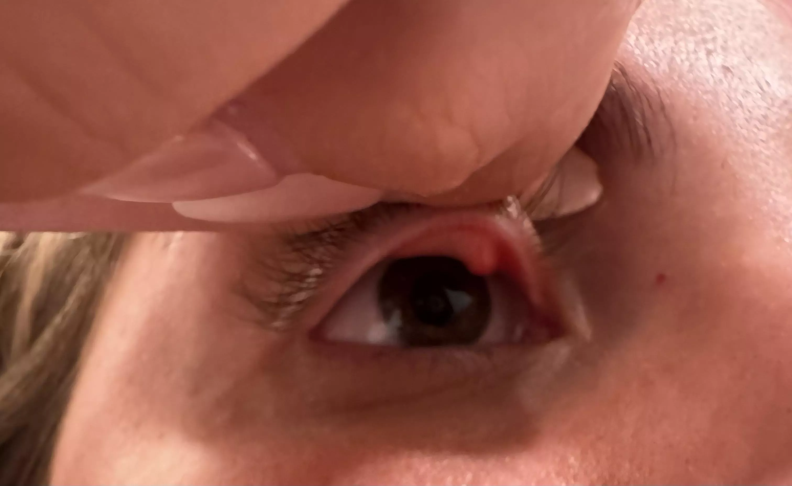 internal stye under upper eyelid (at least i hope it’s just a stye) 