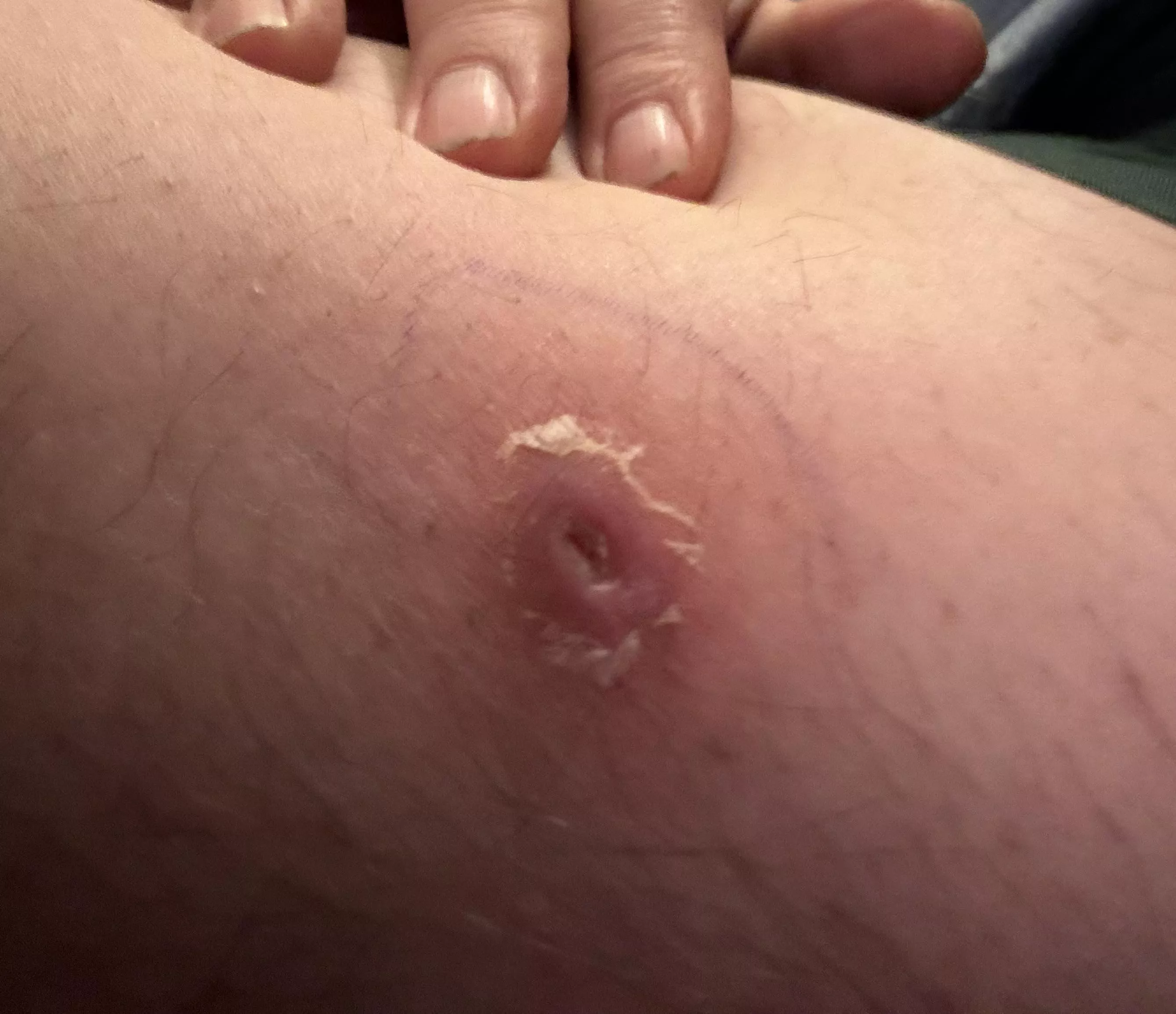 Brown Recluse bite three days after starting antibiotic. Dr.'s office is sending pictures of the bite before meds, I'll post when I get them. Gnarly looking it was.