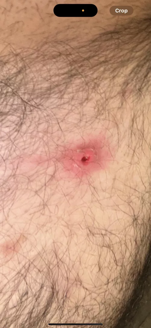 Popped a pimple now there's a deep open wound. Hopefully this isn't an infection