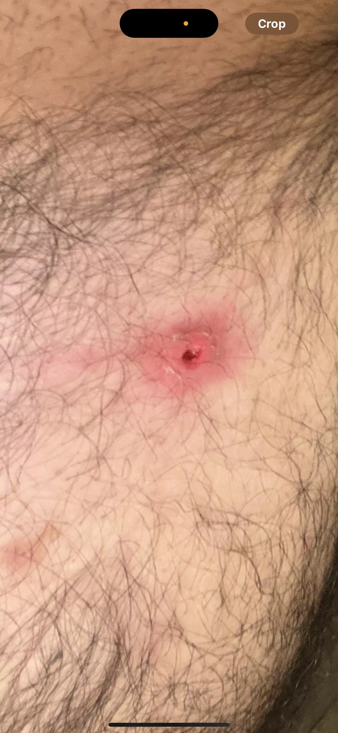 Popped a pimple now there's a deep open wound. Hopefully this isn't an infection