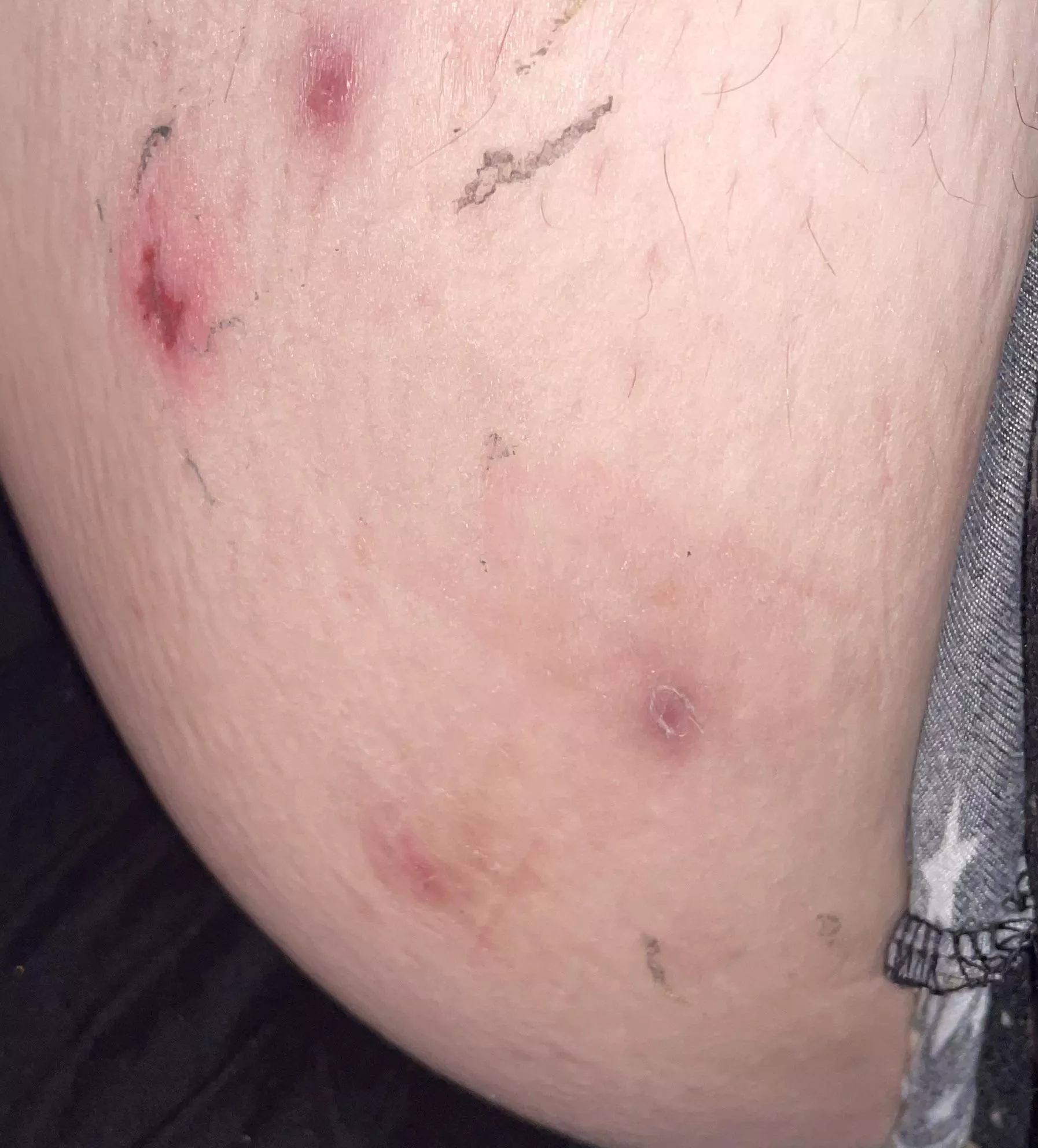 2 healing cysts and bandaid reactions. Ouchie. 🥲