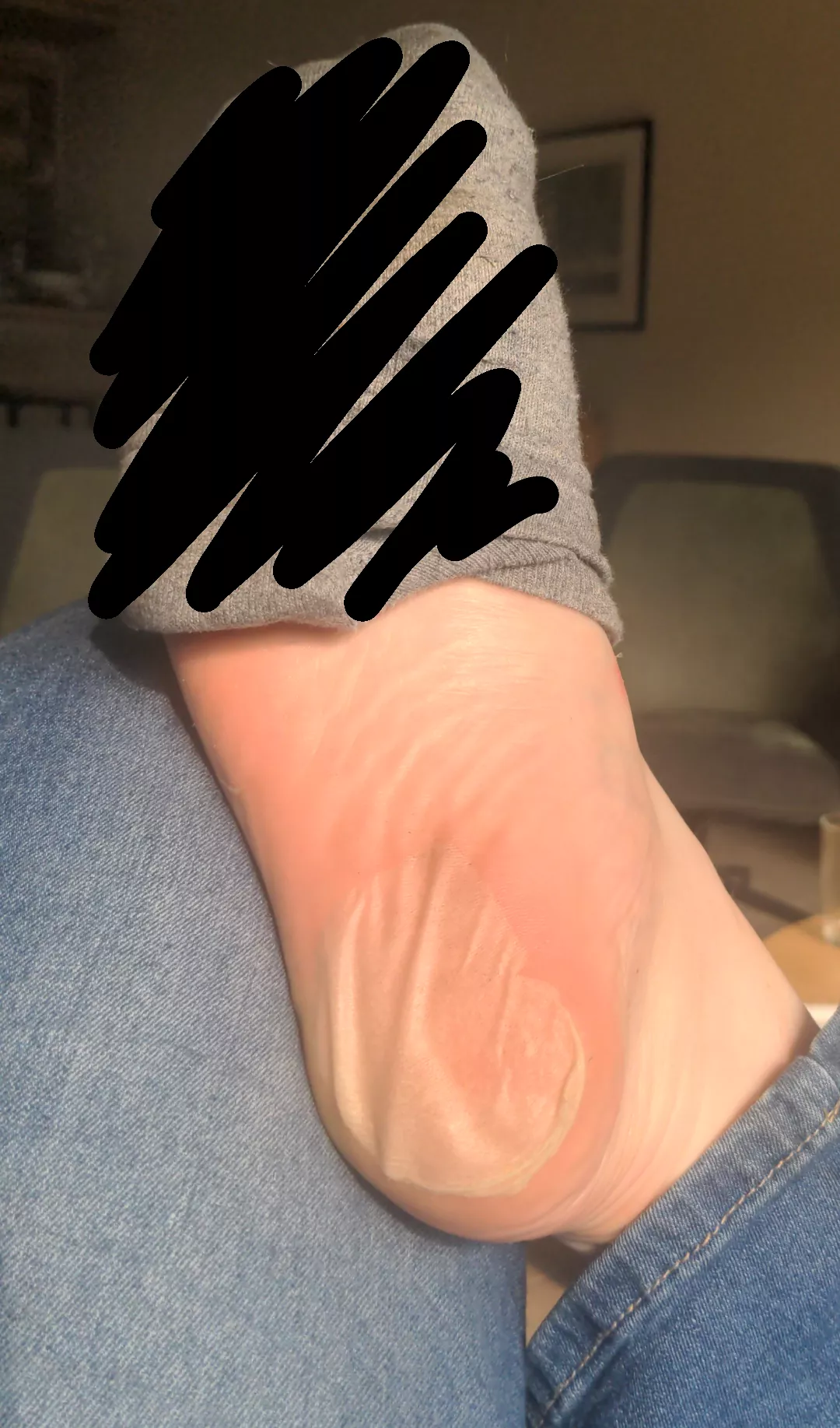 Flap of skin on my heel 