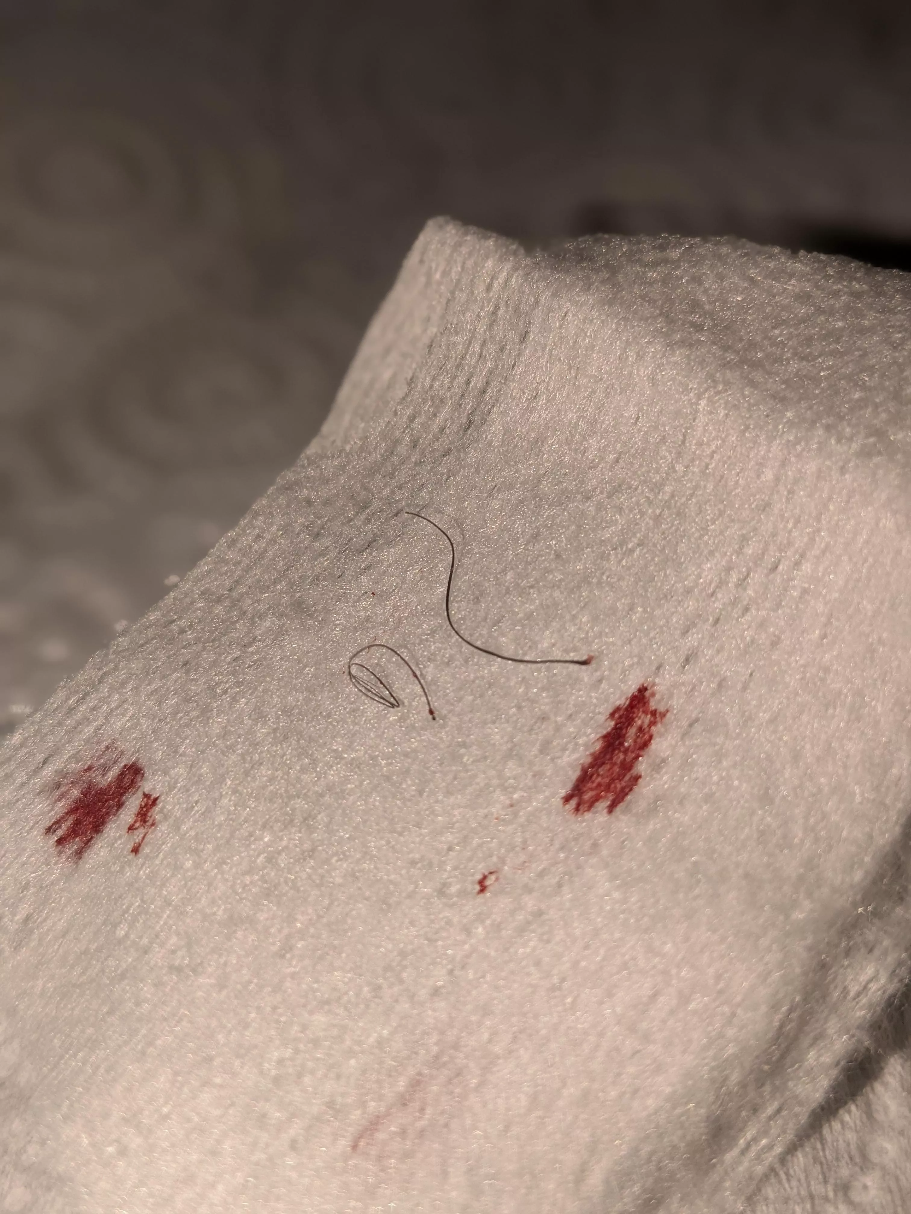 First pop: 3 long ass ingrowns!