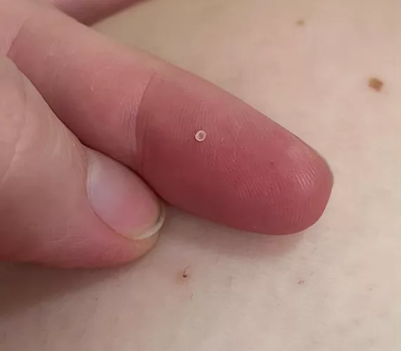 The tiniest, most perfect cyst sac 😂