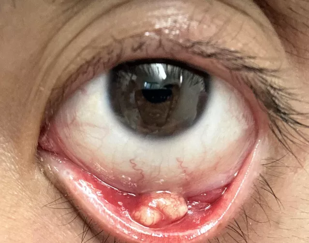 Biggest stye I’ve ever had