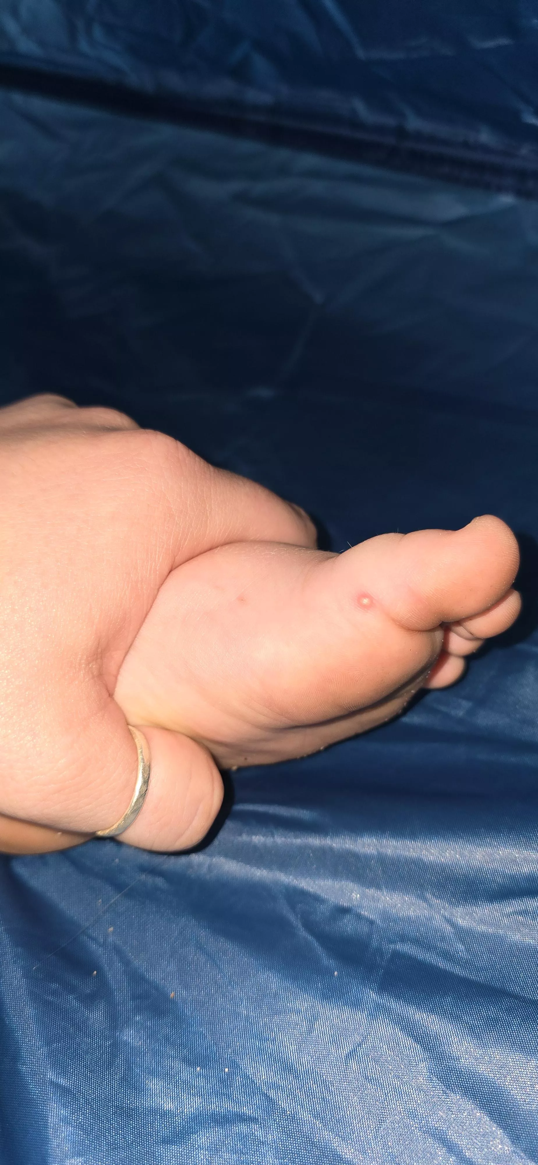 Forbidden pop on toddler's foot. Fire ant bite 😫