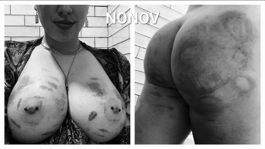 Such beautiful bruises