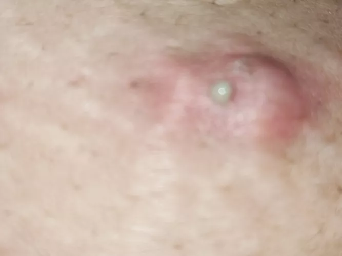 Anyone ever had 2 connecting pimples within a stretchmark? 