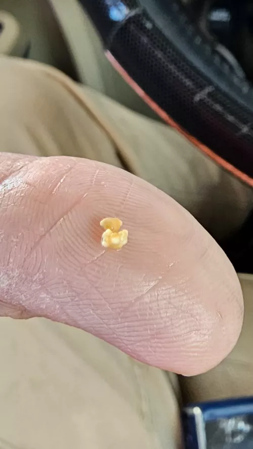 Just popped this out of a salivary gland under my tongue.