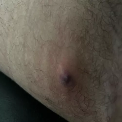 Painful bump on inner thigh