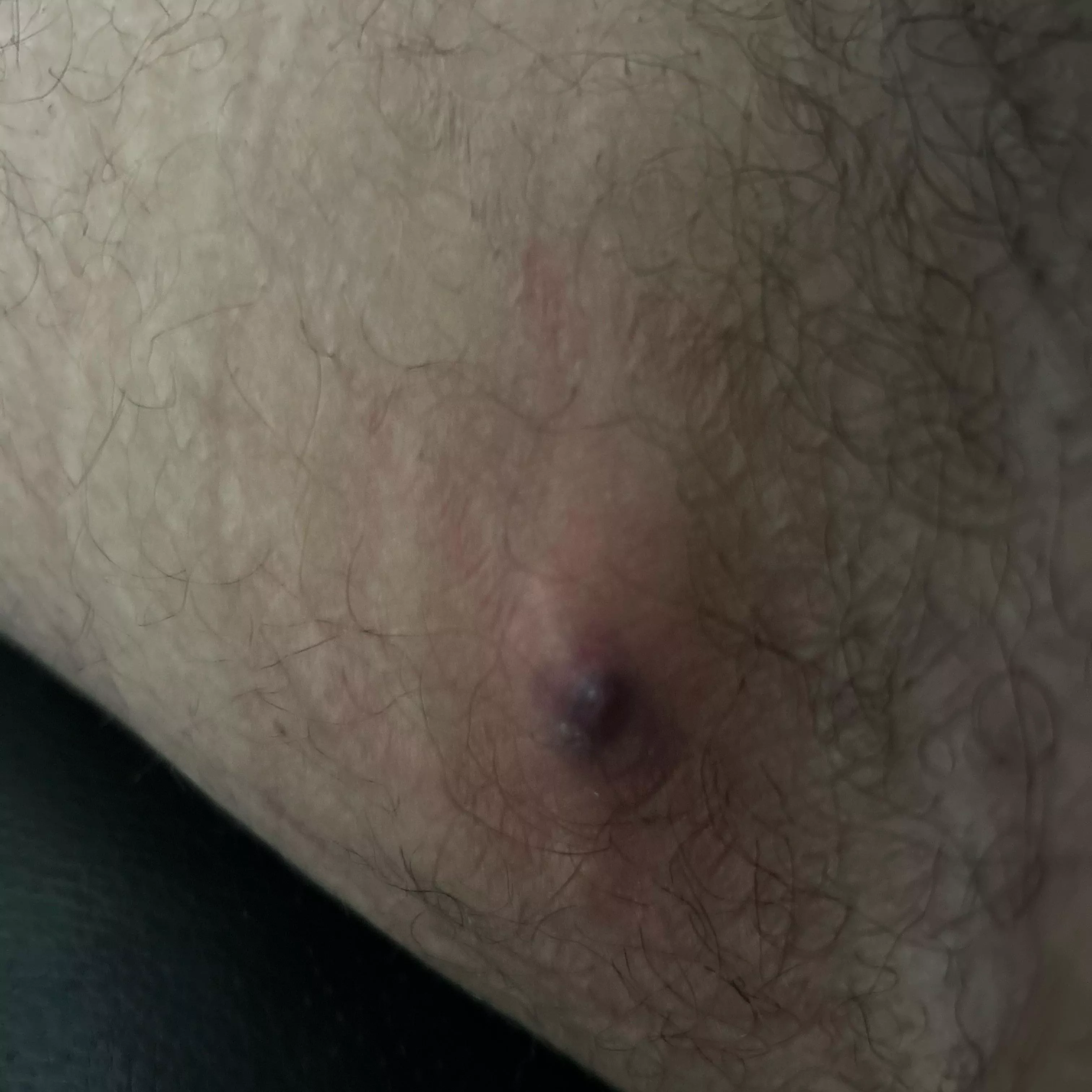 Painful bump on inner thigh