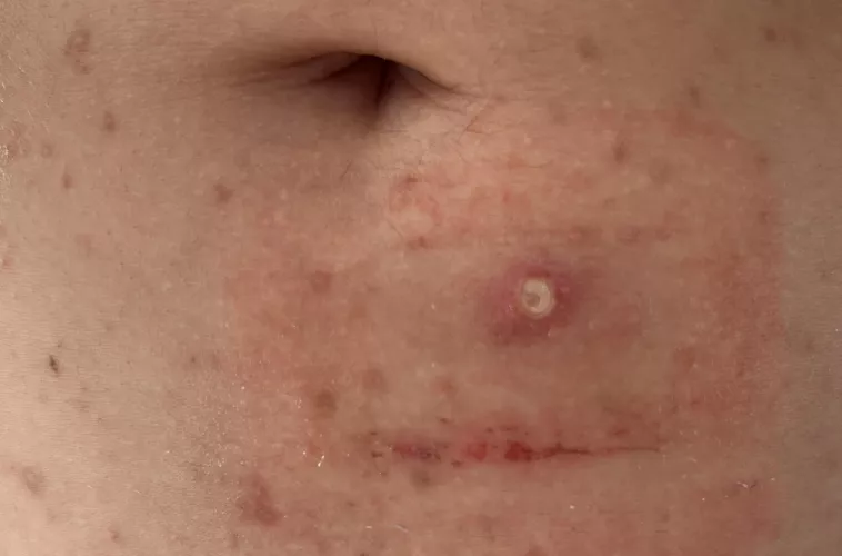 So… I f***ed up. I messed with the wrong pimple apparently.