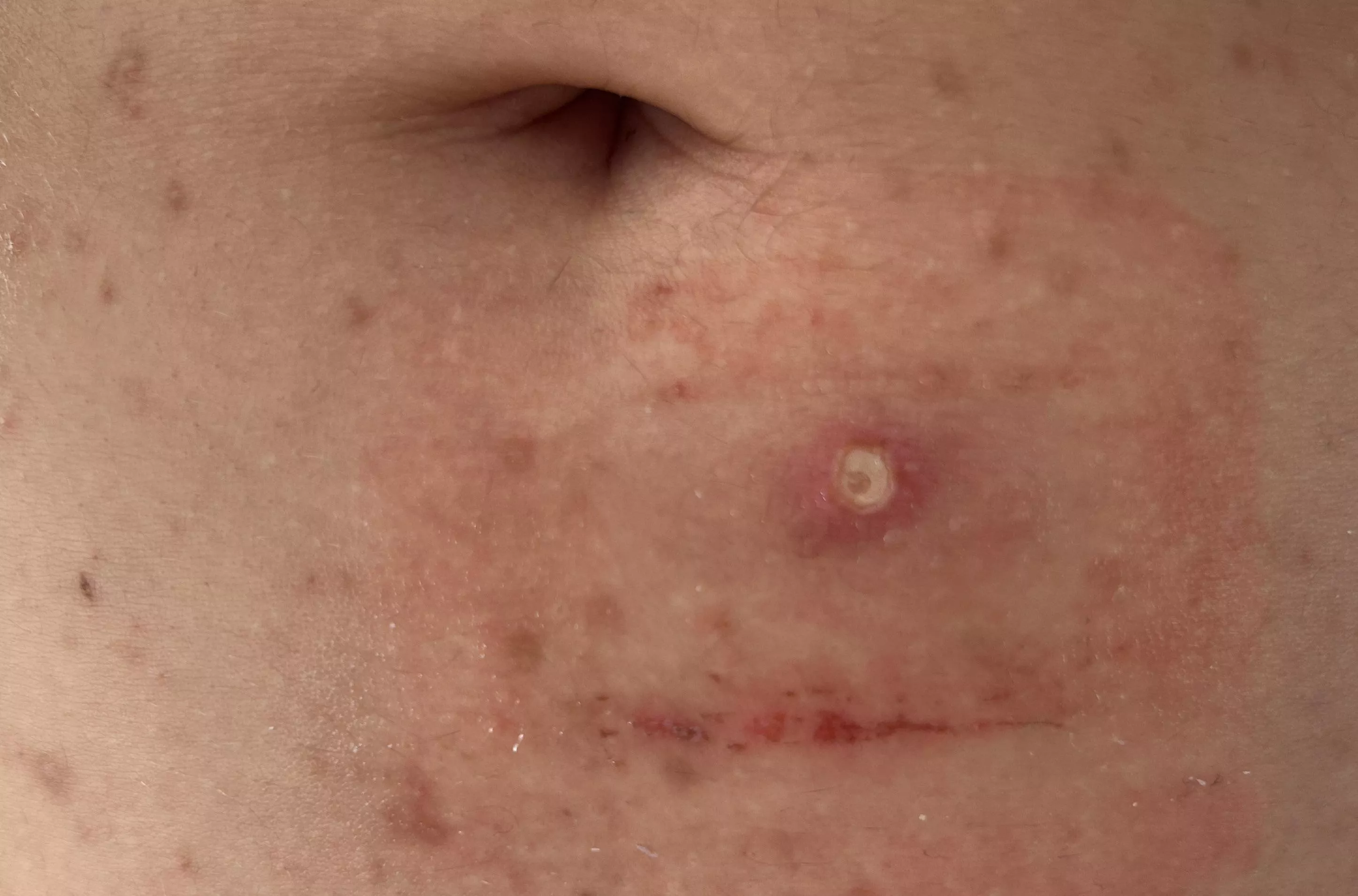 So… I f***ed up. I messed with the wrong pimple apparently.