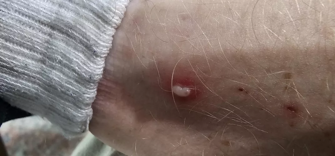 This is from a fire ant. I didn't realize their bites could be so potent. There's two more bites on the other side of my ankle but they're not as juicy yet. 