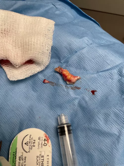 Finally got this little guy removed today 
