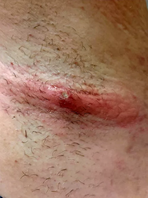 Forbidden pop, MRSA in armpit