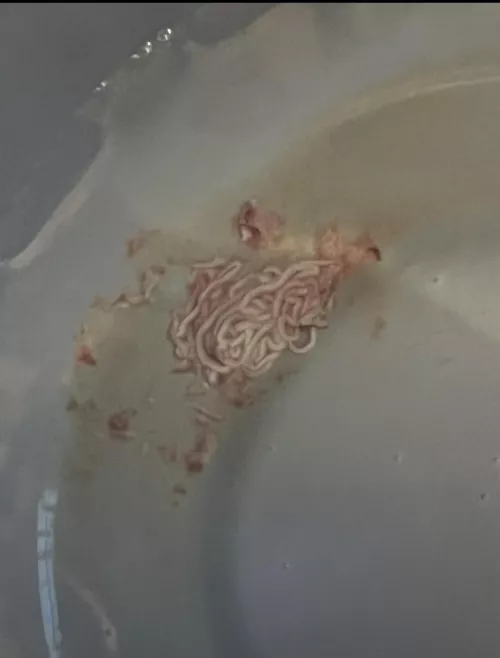 What squirted out on its own from sitting a sitz bath (Pilonidal)