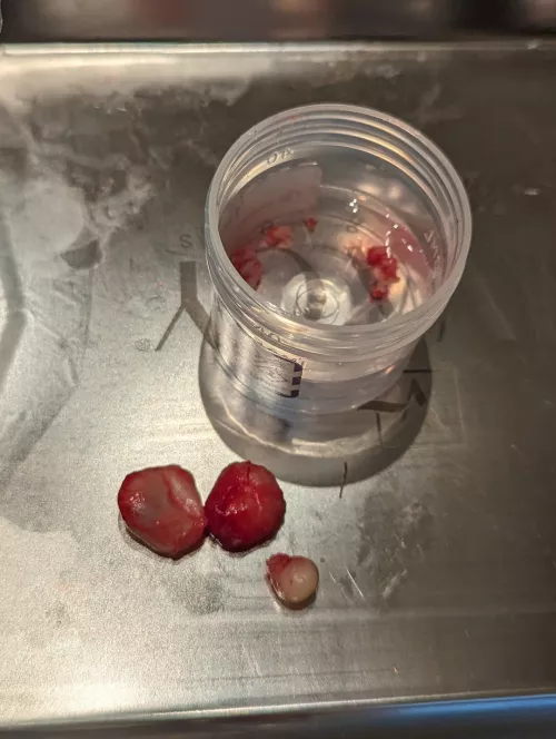 Some cysts I had removed today 