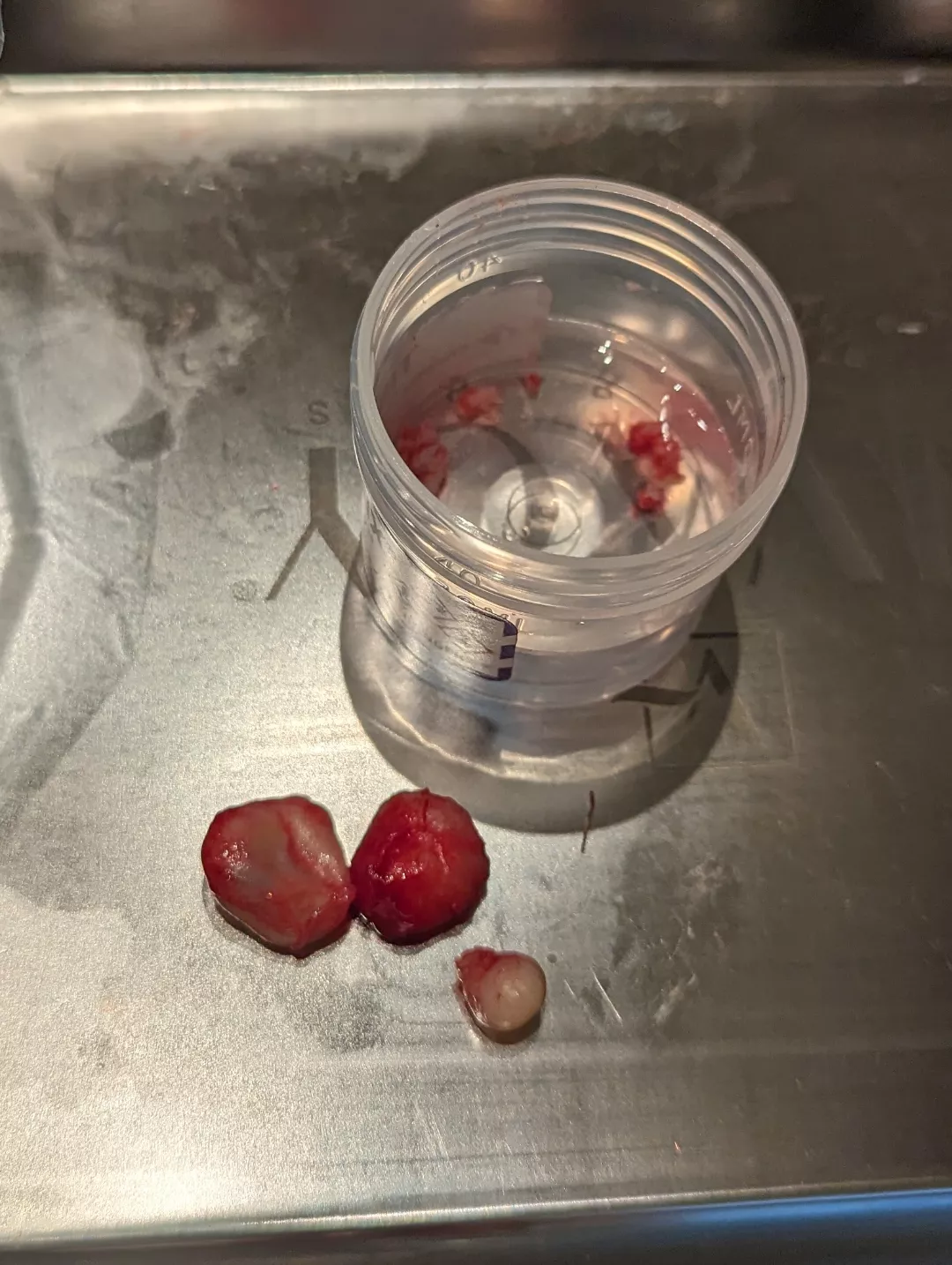 Some cysts I had removed today 