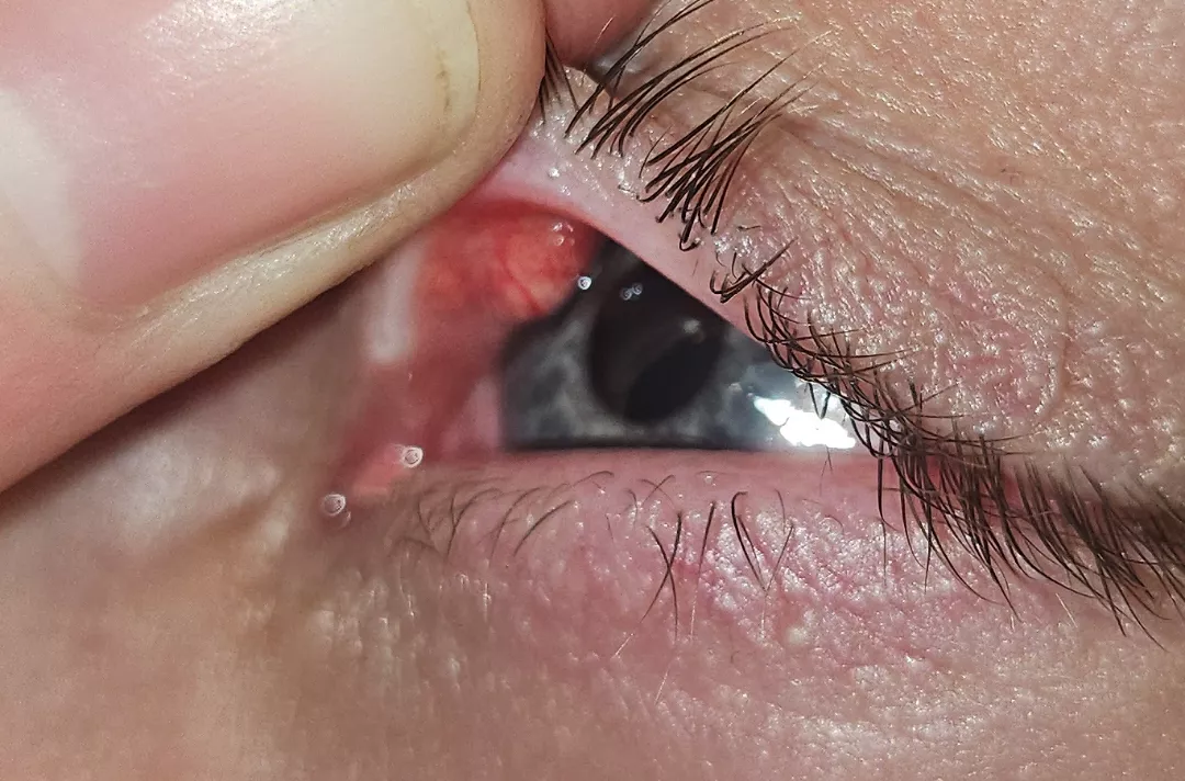 Found this possible stye in my friends upper eyelid 