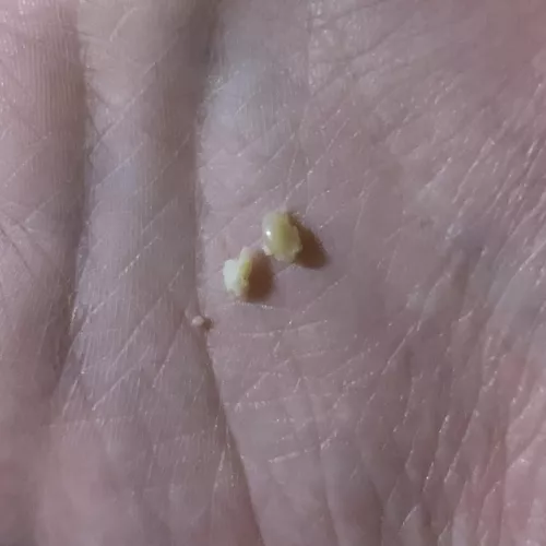 Just got this unexpectedly massive blackhead thing out of my side, sadly didn't get it on video :(
