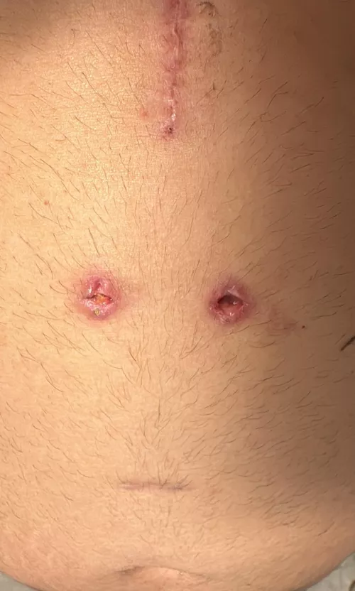 Stitches were pulled yesterday I pealed the scab today 