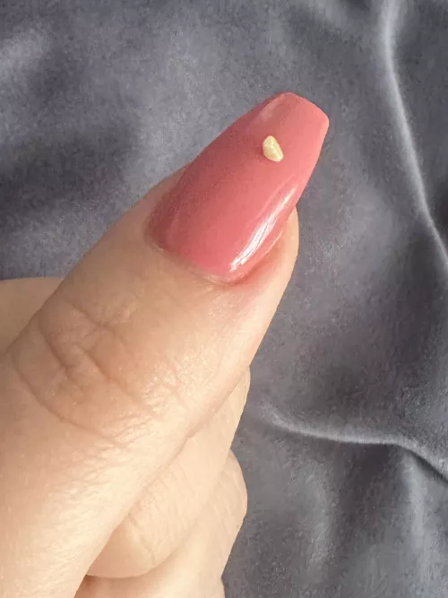 The tonsil stone but I am tonsil less?