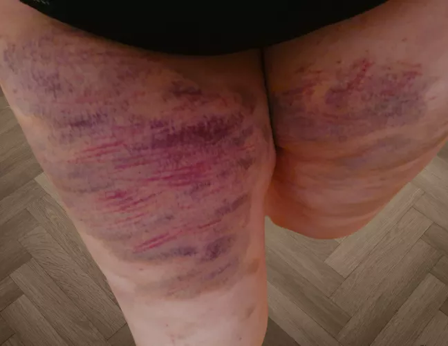 Another painful punishment