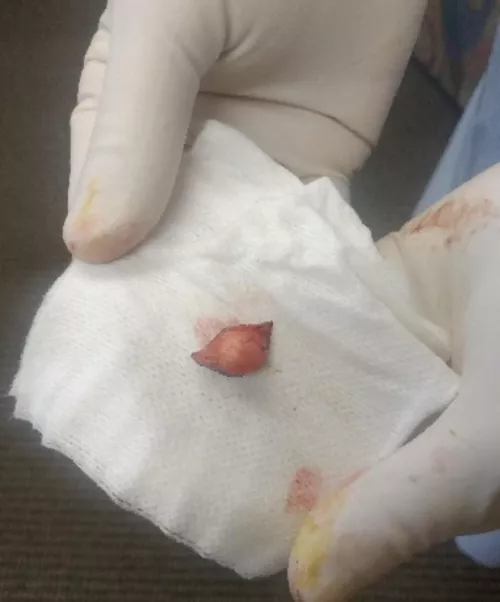 Cyst removed from temple 